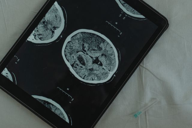 A traumatic brain injury can affect memory, work, and family life for years. A brain injury lawyer in Bakersfield documents the future medical costs and lost earning capacity that insurers try hardest to leave out of an offer. Brain injury lawyer in Bakersfield reviewing a traumatic brain injury scan with an injured client